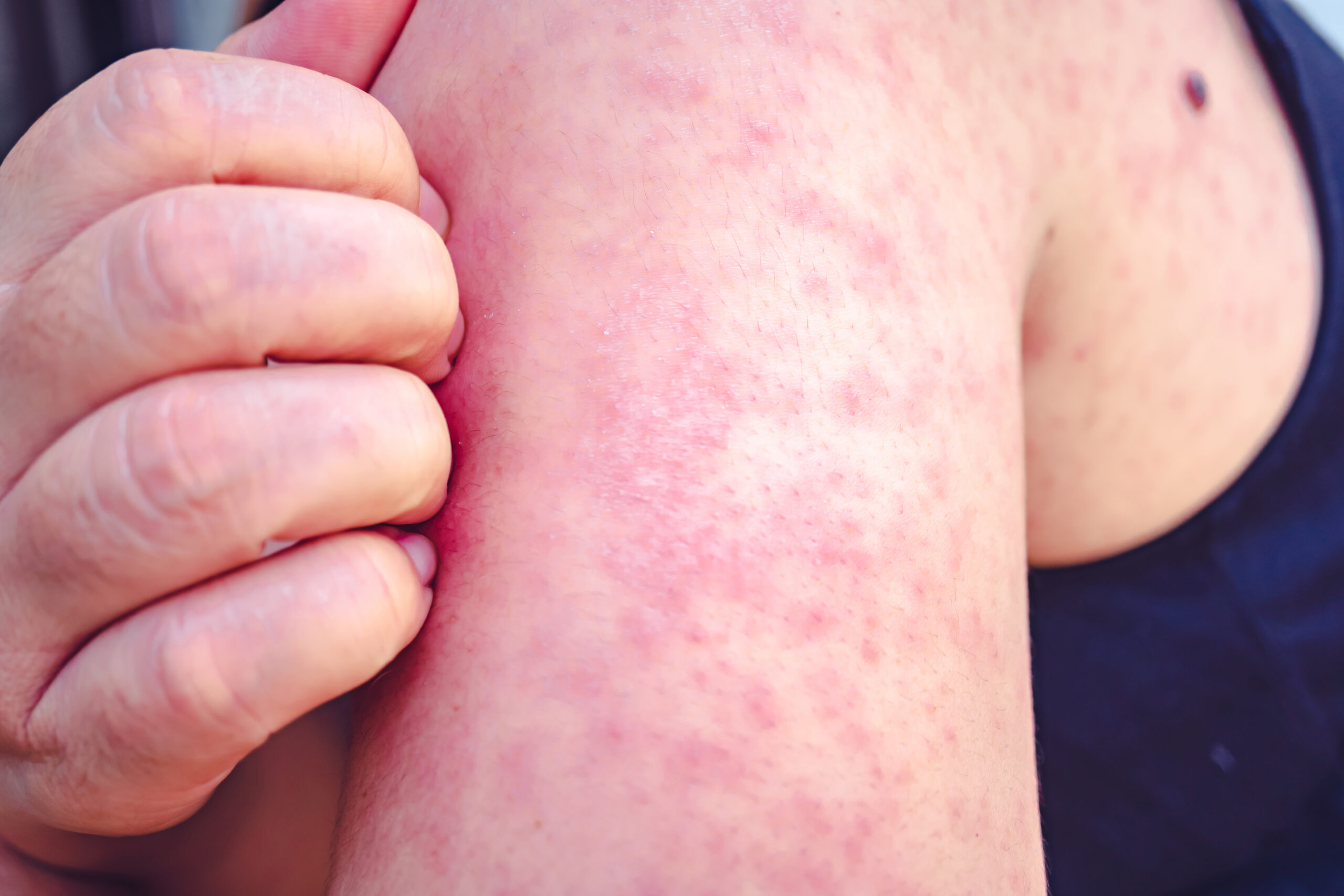 Measles Outbreak Reported in Another State: Health Alert