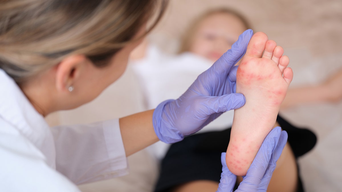 Hand, Foot, and Mouth Disease (HFMD) Surge in US States: Possible Fatal Case Reported