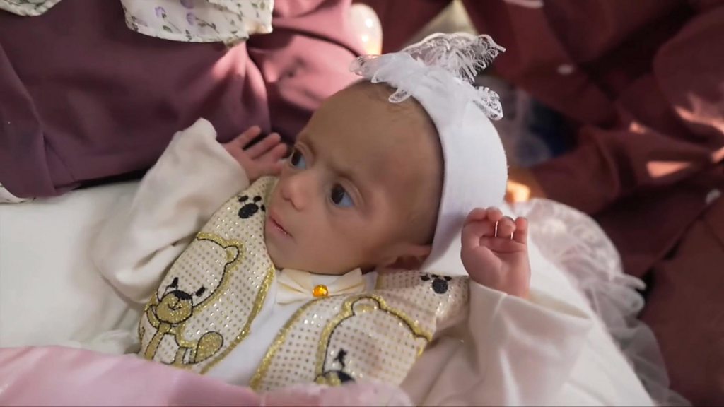 Malnourished Baby Siwar Evacuated from Gaza to Jordan for Treatment