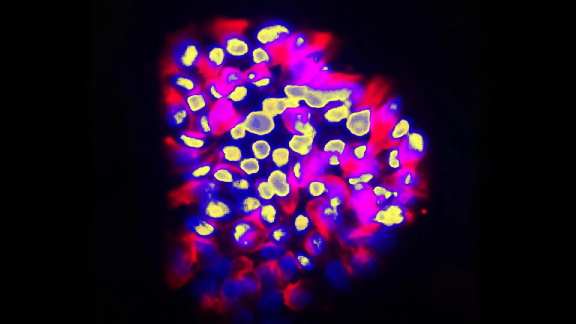 New AI Tool Predicts Cancer Spread Accuracy